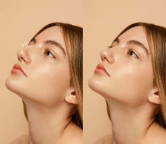 Dermal Fillers for Non-Surgical Nose Jobs: What to Consider