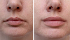 Is Using Lip Filler Right for You?